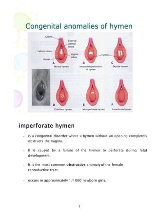 Imperforate hymen